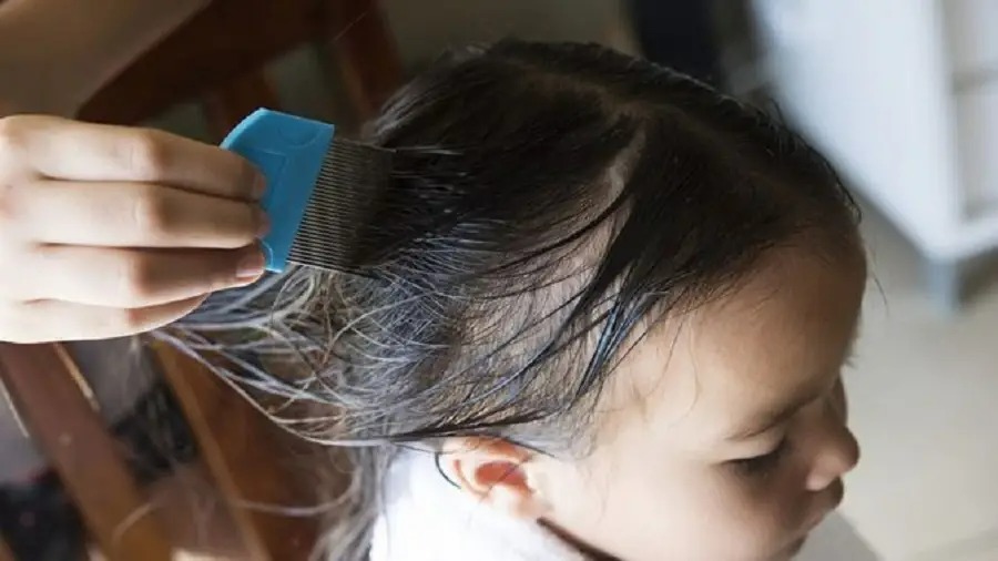 Panduan Cara Mengatasi Kutu Rambut Anak